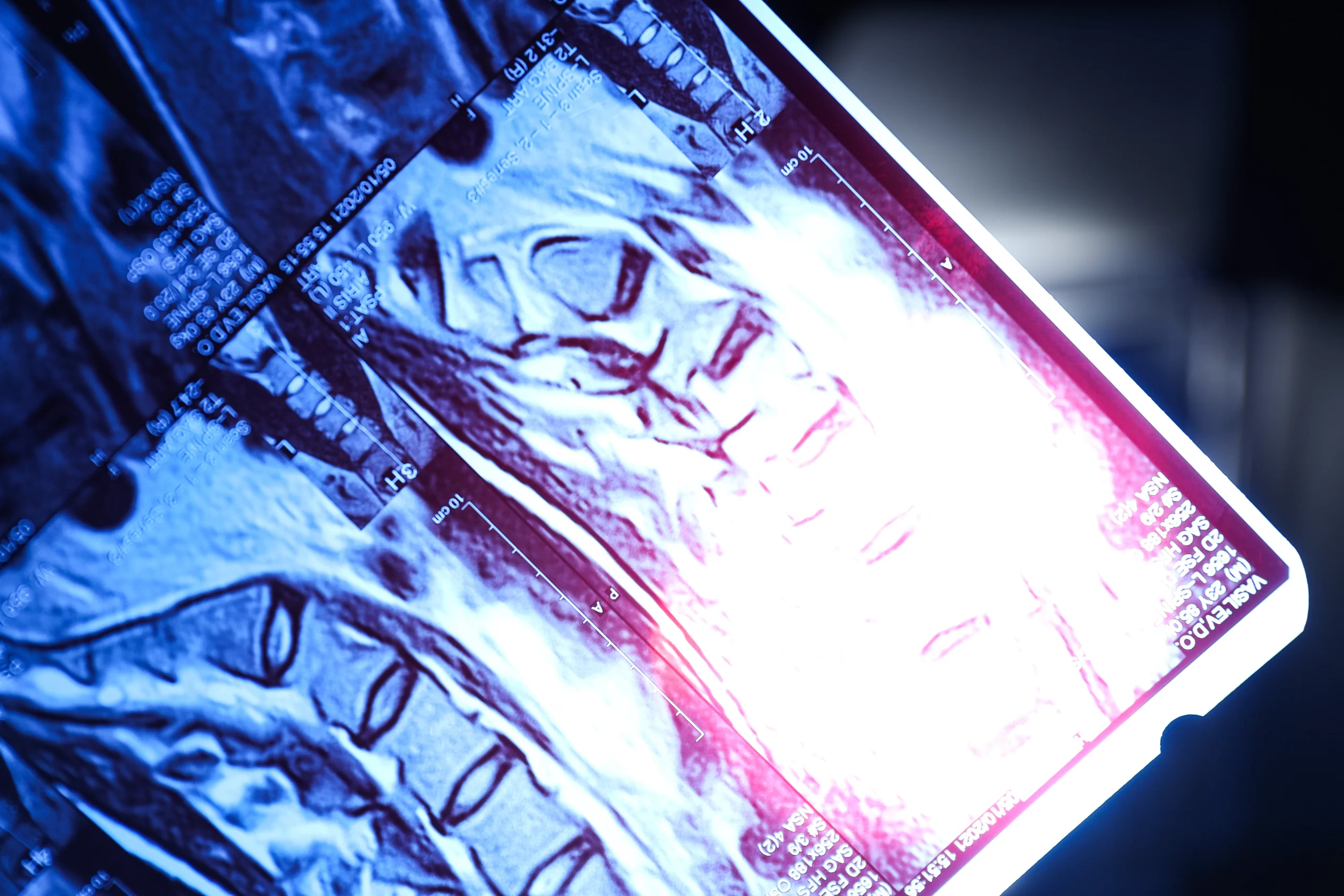 MRI scan highlighting prostate cancer