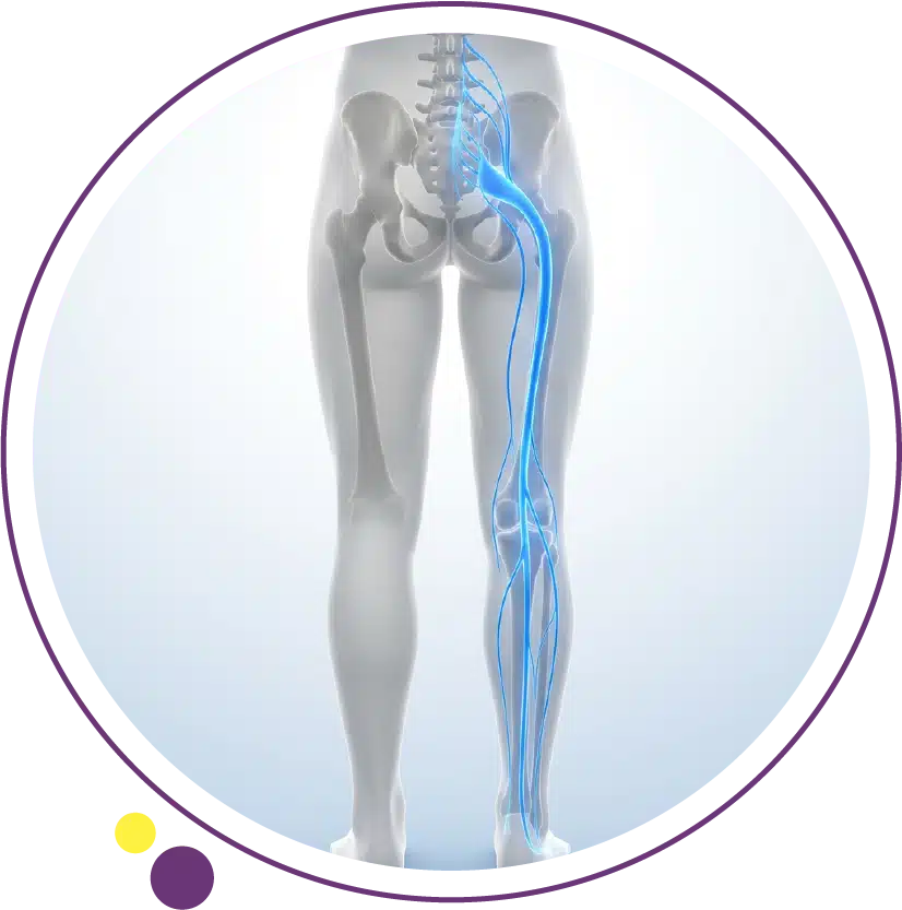 sciatica symptoms