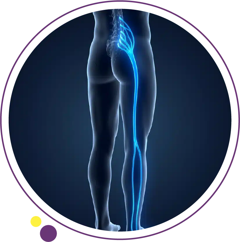 ماهو عرق النسا