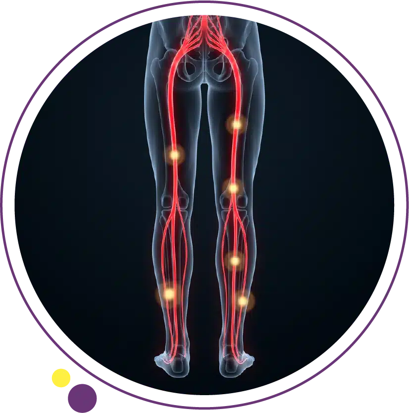 أعراض عرق النسا: 10 علامات تدل على ضغط العصب وكيف تميزها