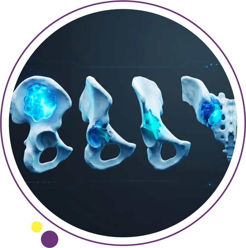 types of bone cancer