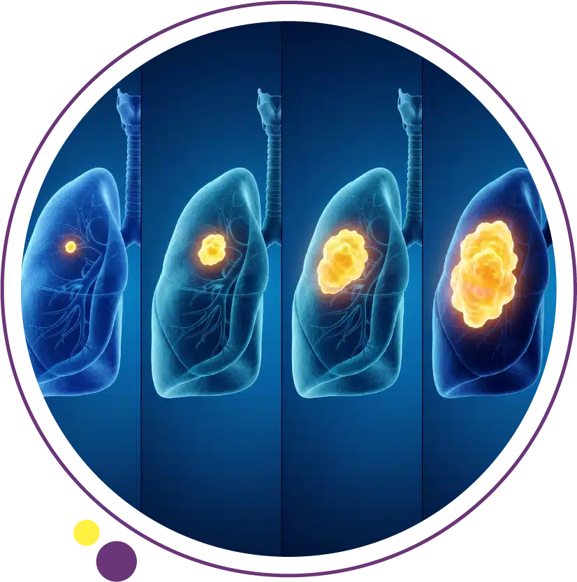 lung cancer stages