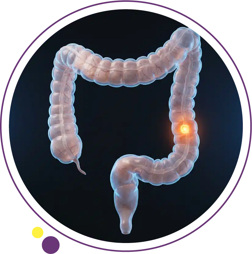 colon cancer symptoms