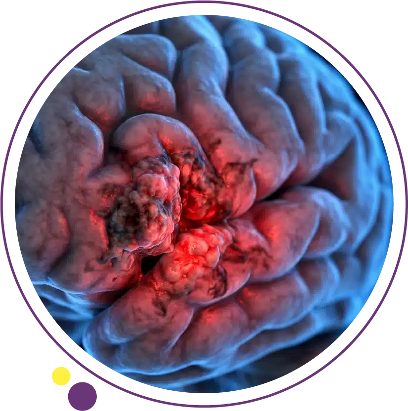 glioblastoma