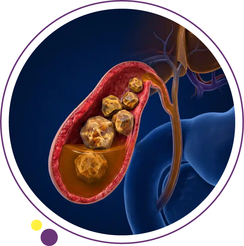 kidney stones symptoms